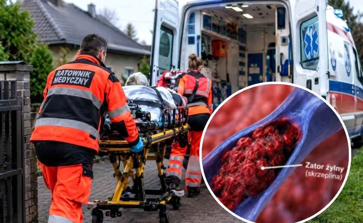 przyczyny udaru mózgu
